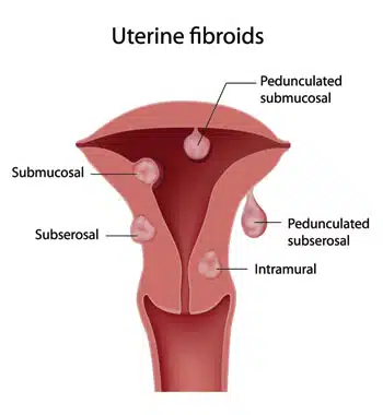 uterus-with-fibroids