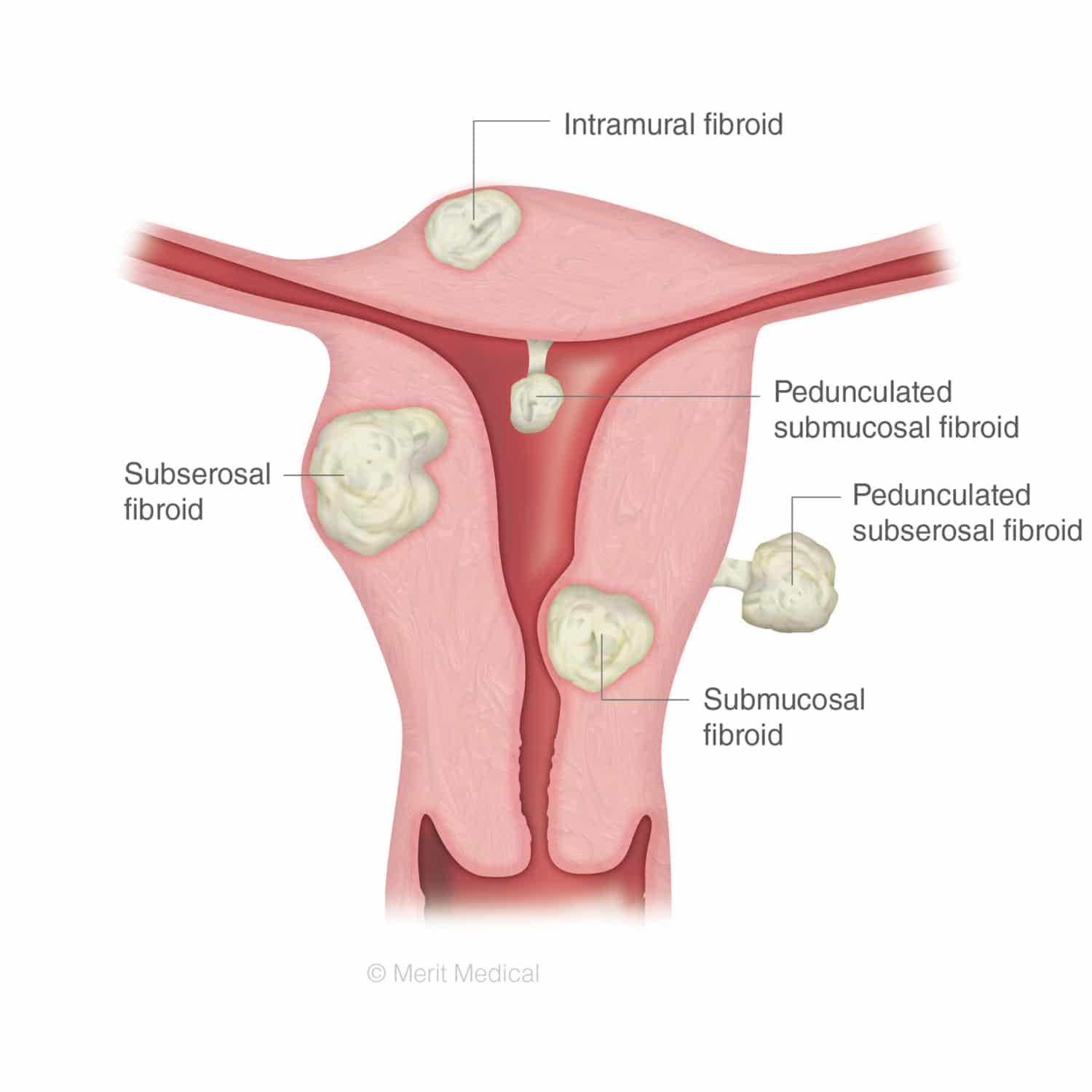 symptoms-of-uterine-fibroids