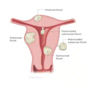 UFE diagram - types of fibroids