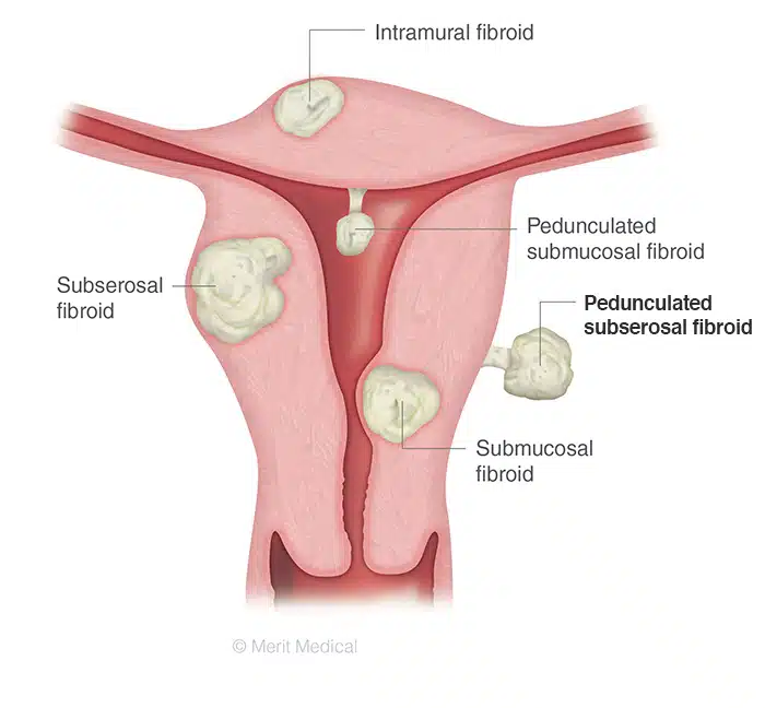 Pedunculated Subserosal Fibroid UFE